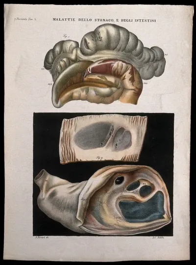 Three sections of diseased stomach and intestines, numbered for key