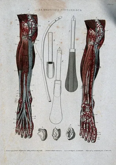 Top left and right, arteries of the leg; centre, surgical instruments for piercing a hydrocele and extracting the fluid; bottom centre, pieces of cartilage