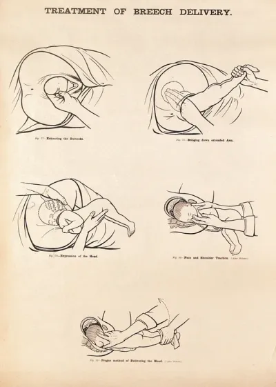 Treatment of breech delivery