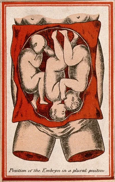 Triplets, shown in the uterus: illustration showing the position of the foetuses in a plural position