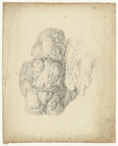 Tumor growing from a man's buttocks, attached to the pelvis