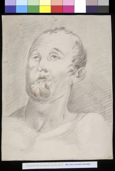 Tumor of the lower lip