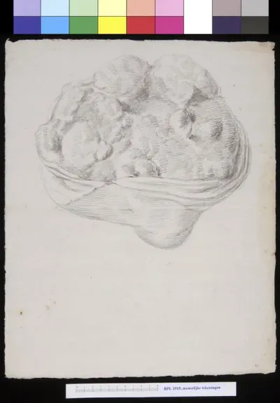 Tumor of the uterus