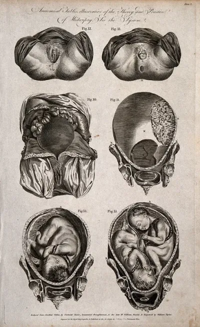 Two diagrams of a childs head starting to emerge from the vagina; two cross-sections of an exposed uterus and two diagrams of a single child and twins in the womb
