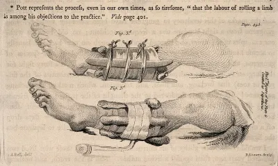 Two diagrams of legs in splints, illustrating how to set a fractured limb