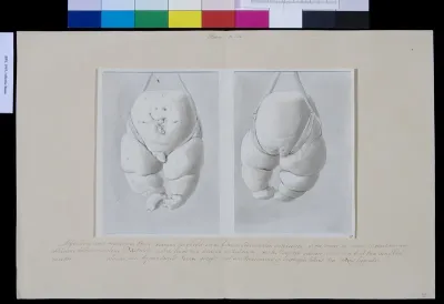 Two drawings of a deformed foetus