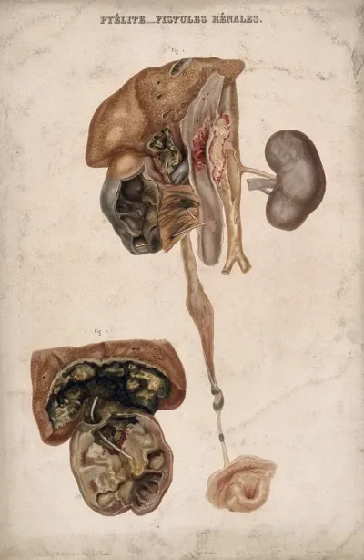Two examples of a disease of the kidney