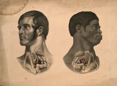 Two heads of men (one white, one black African), showing dissection of muscles and blood-vessels of the subclavian region of the chest