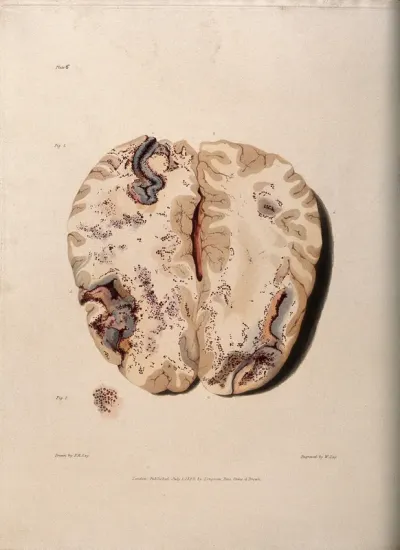 Two sections of diseased brain
