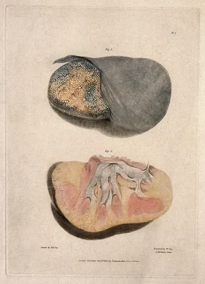Two sections of diseased kidney