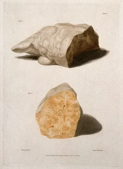 Two sections of diseased liver