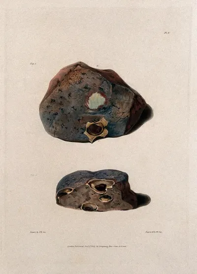 Two sections of diseased lung