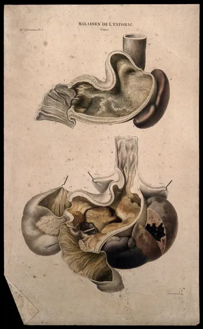 Two sections of diseased stomach (cancer), numbered for key