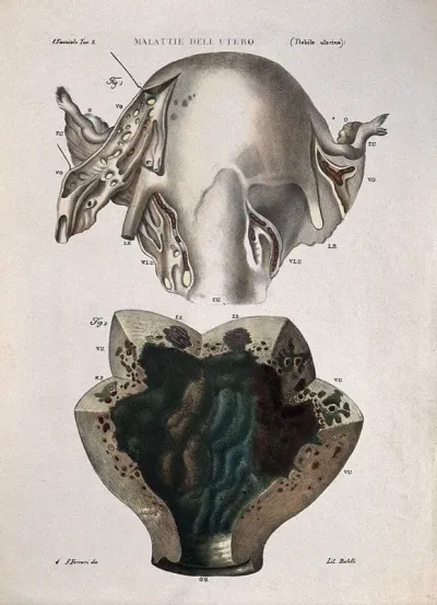 Two sections of diseased uterus, numbered for key