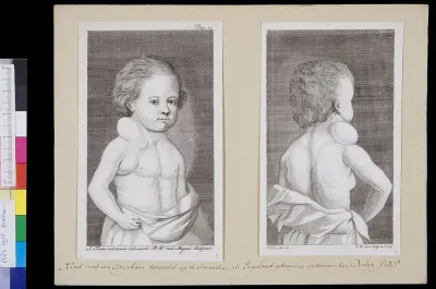 Two views of a child with a tumor