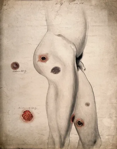 Ulcers and diseased areas of tissue on the legs and buttocks of a man, with two details showing a cicatrix and an ulcer on the left leg