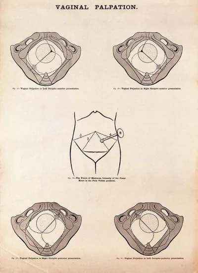 Vaginal palpation in pregnancy