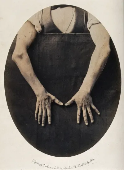 Wilhelm Haack, his hands and forearms exposed against a black background, thumbs pointing towards each other, revealing less mobility in right hand
