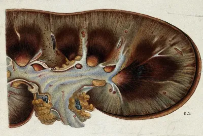 Yellow fever: section of a kidney of a patient infected with yellow fever