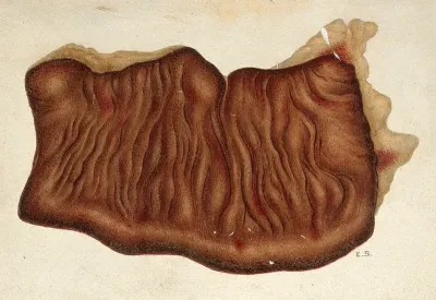 Yellow fever: section of the large intestine of a patient infected with yellow fever