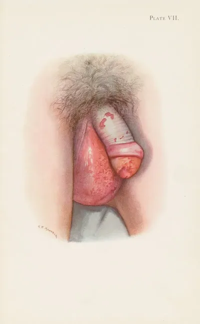 Plate VII Burning Of Scrotum And Penis By Mustard Gas