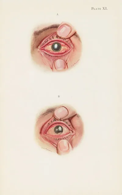Plate XI A Severely Burned Eye In The Acute Stage B Slightly Later Stage Of Acute Burning