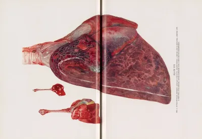 Plate Xvi Fig 1 Lungs Of Goat Monkey And Rat Surviving Respectively 4 Hours And 10 Minutes 4 Hours And 55 Minutes And 6 Hours After Exposure For 15 Minutes To Chlorpicrin