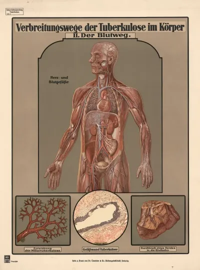 Routes Of Tuberculosis Transmission In The Body Ii The Bloodstream