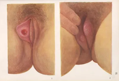 Venereal Diseases Syphilis Pl 03