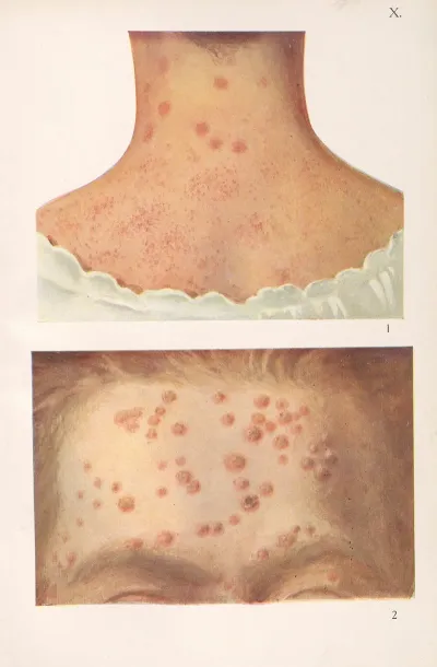 Venereal Diseases Syphilis Pl 10