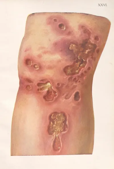 Venereal Diseases Syphilis Pl 26