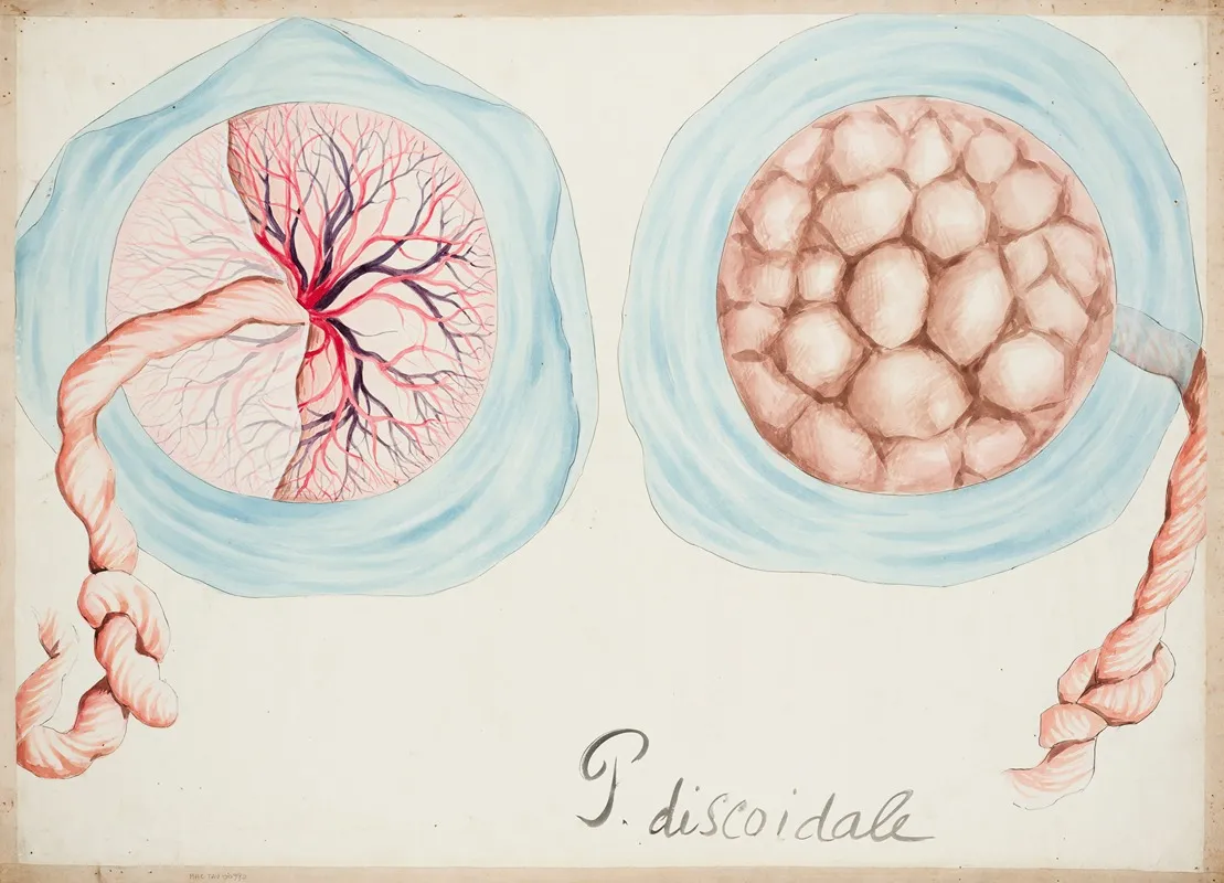 Discoid Placenta