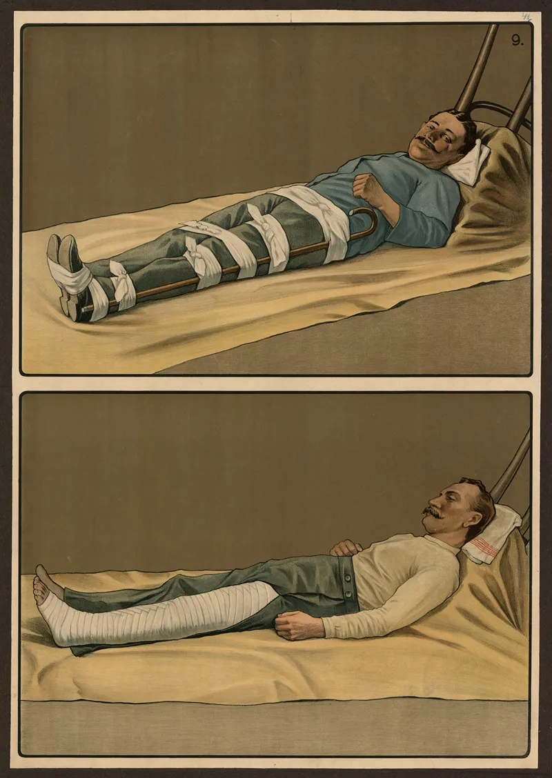 Emergency Treatment For Broken Bones