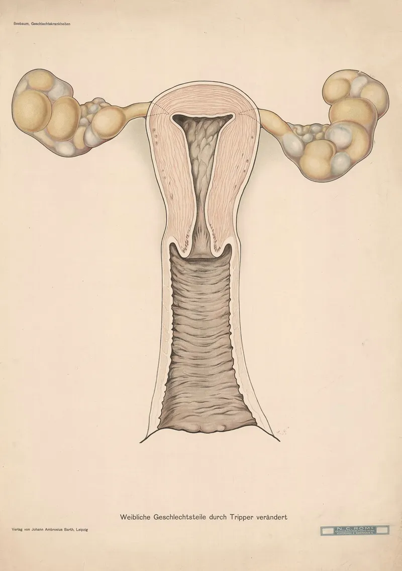 Female Reproductive Organs Altered By Gonorrhea by Verlag von Johann Ambrosius Barth - Canvas Print