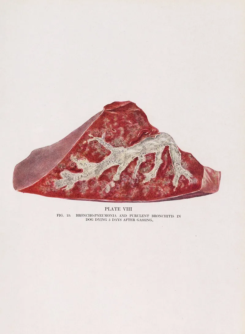 Plate Viii Fig 13 Broncho Pneumonia And Purulent Bronchitis In Dog Dying 5 Days After Gassing by Milton C. Winternitz - Canvas Print