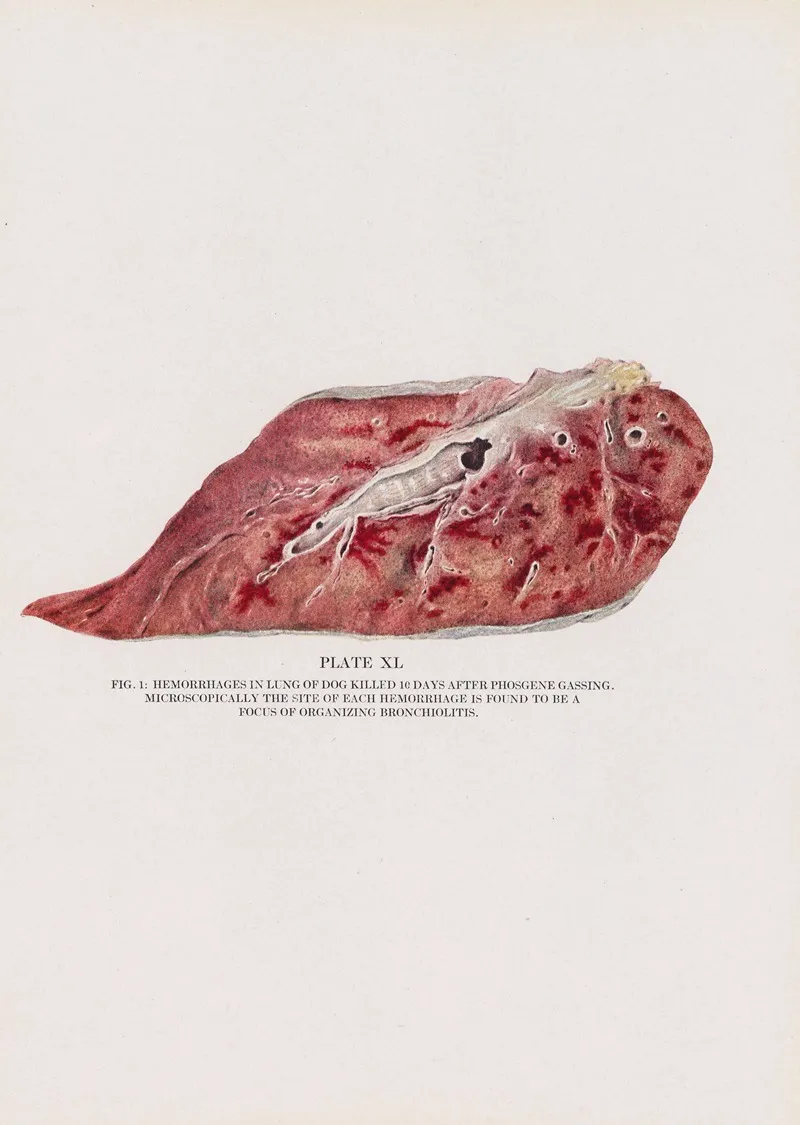 Plate Xl Fig 1 Hemorrhages In Lung Of Dog Killed 10 Days After Phosgene Gassing by Milton C. Winternitz - Canvas Print