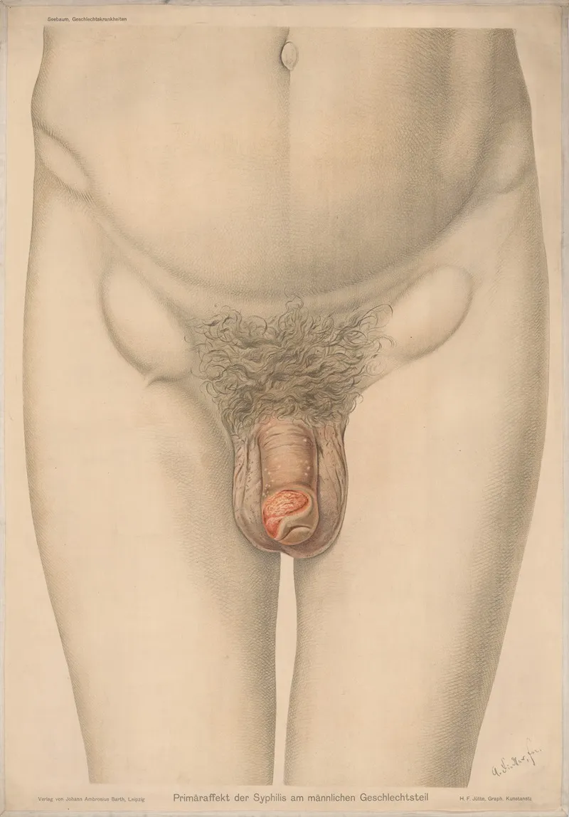 Primaraffekt Der Syphilis Am Mannlichen Geschlechtsteil by Verlag von Johann Ambrosius Barth - Canvas Print