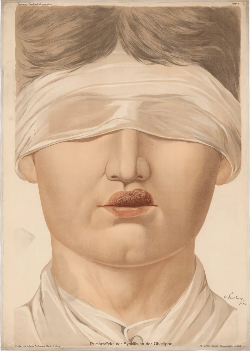 Primaraffekt Der Syphilis An Der Oberlippe by Verlag von Johann Ambrosius Barth - Canvas Print